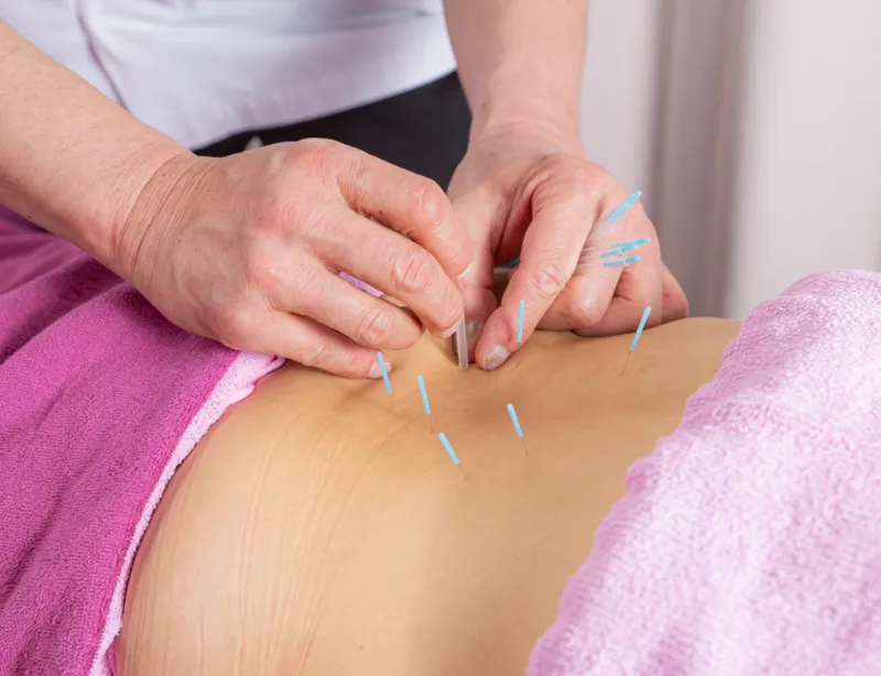 鍼灸