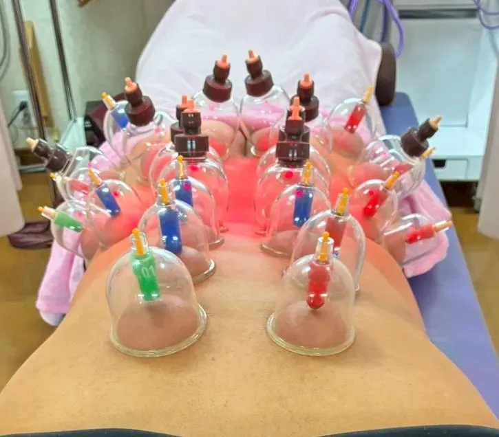 吸玉施術の様子