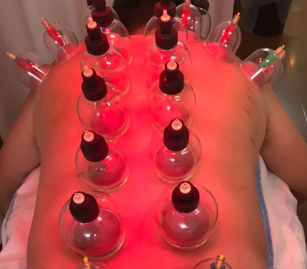 吸玉施術の様子