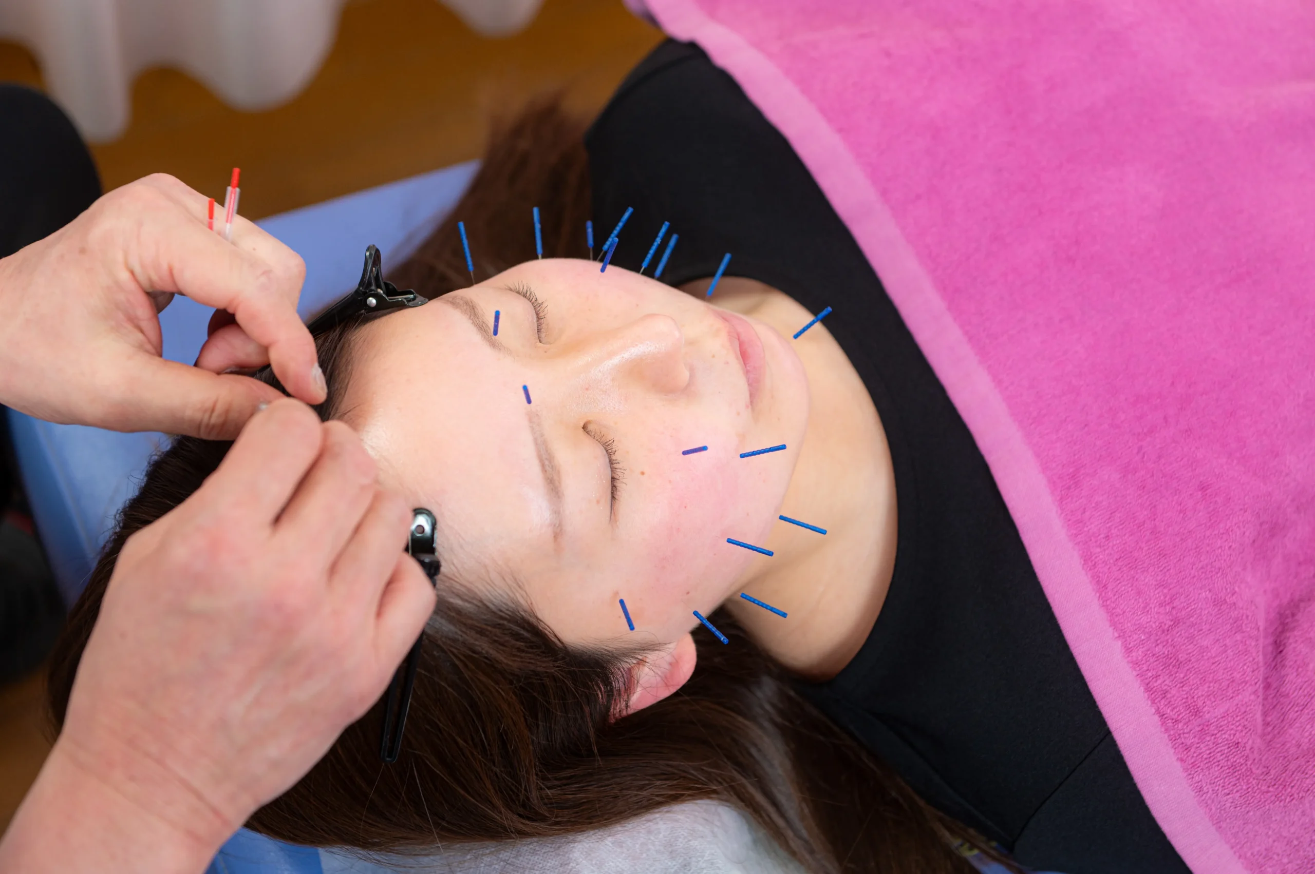 鍼施術の様子